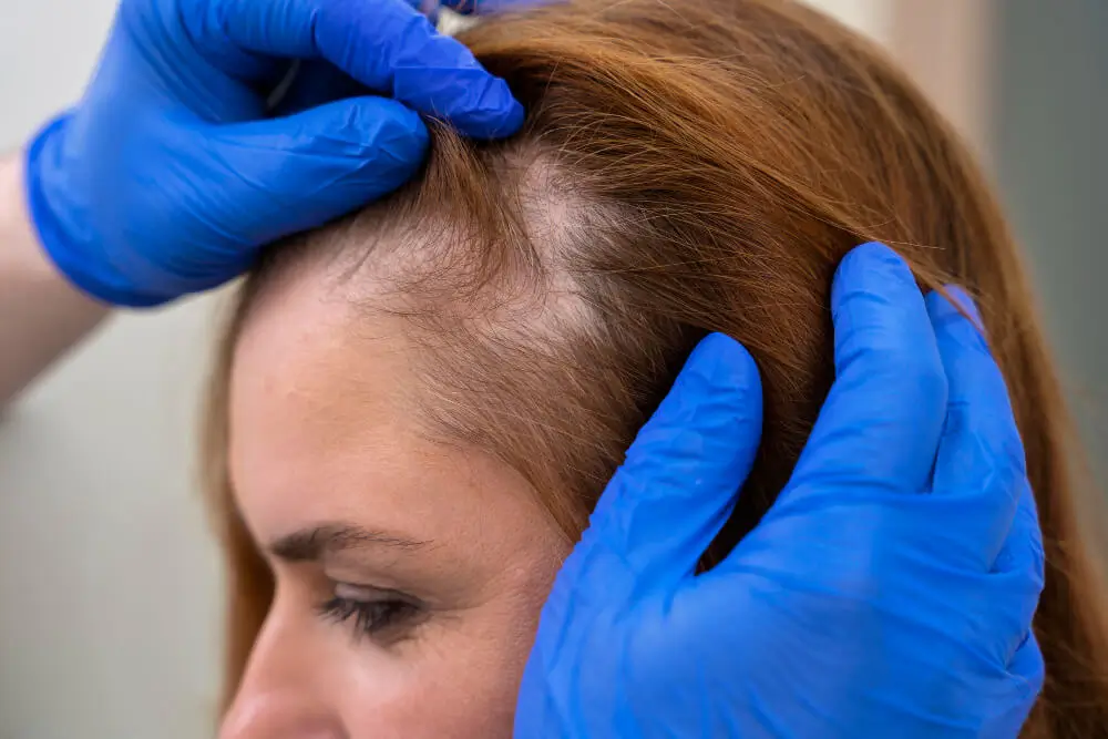 Alopecia difusa